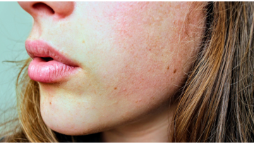 Pelle più sensibile in primavera: come rafforzare la barriera cutanea